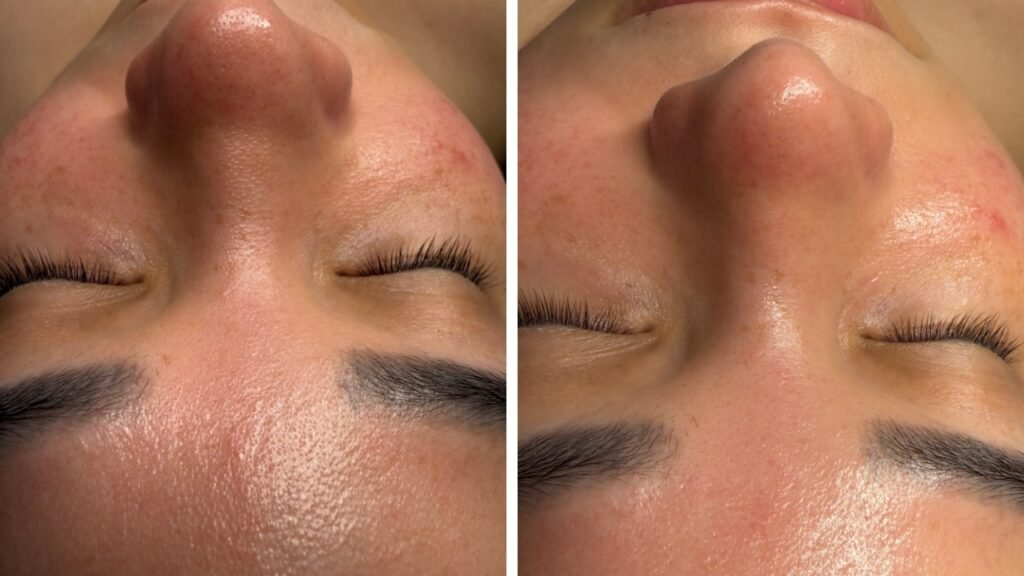 HydraFacial deep cleanse treatment at Skin Care Supreme, Westbury NY