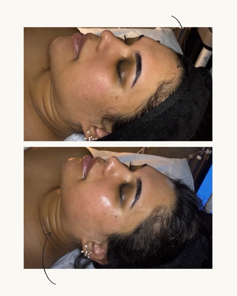 HydraFacial glowing skin results at Skin Care Supreme, Westbury NY